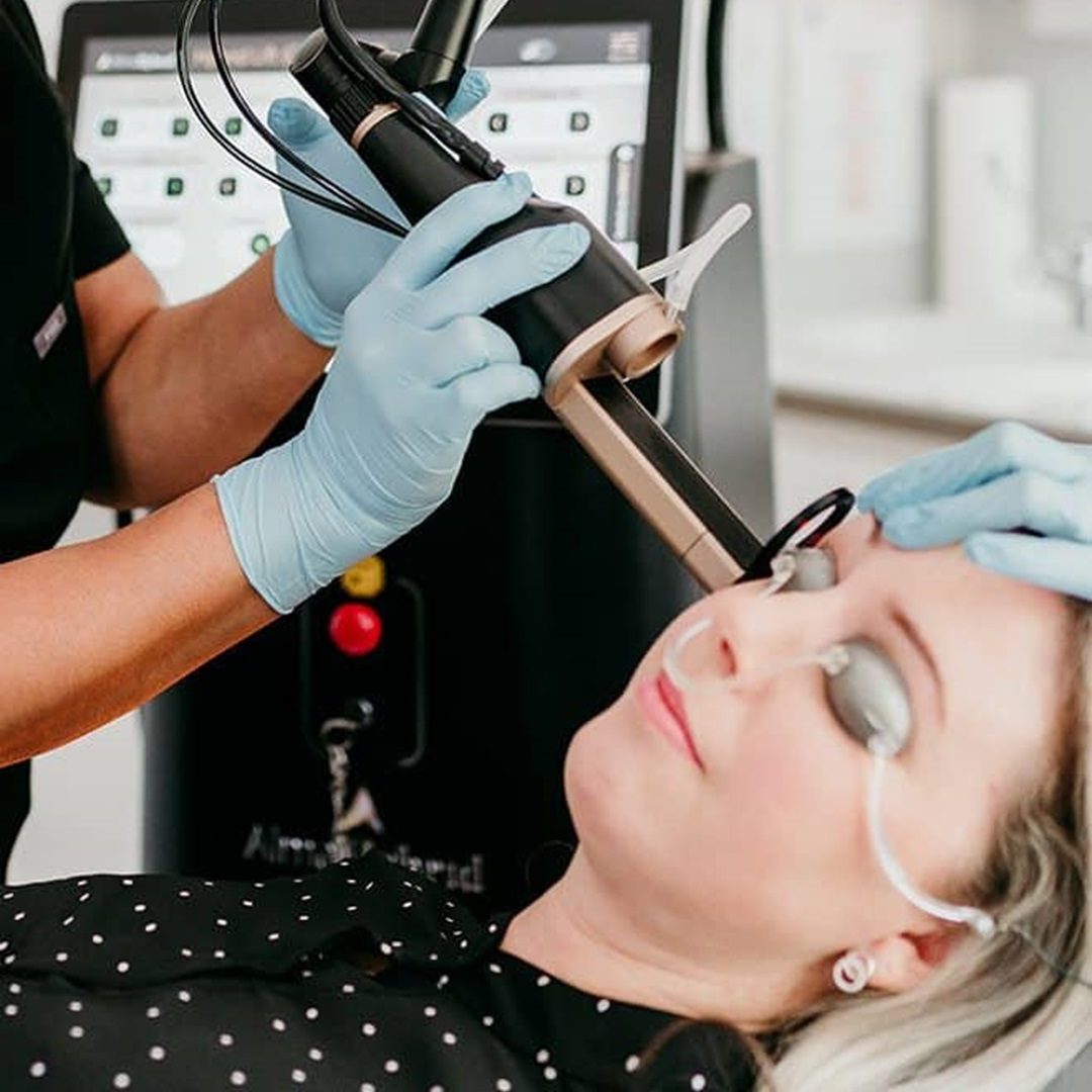 Alma Hybrid laser resurfacing