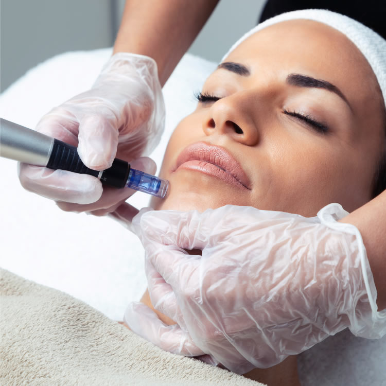 Microneedling treatment at Symbios Aria
