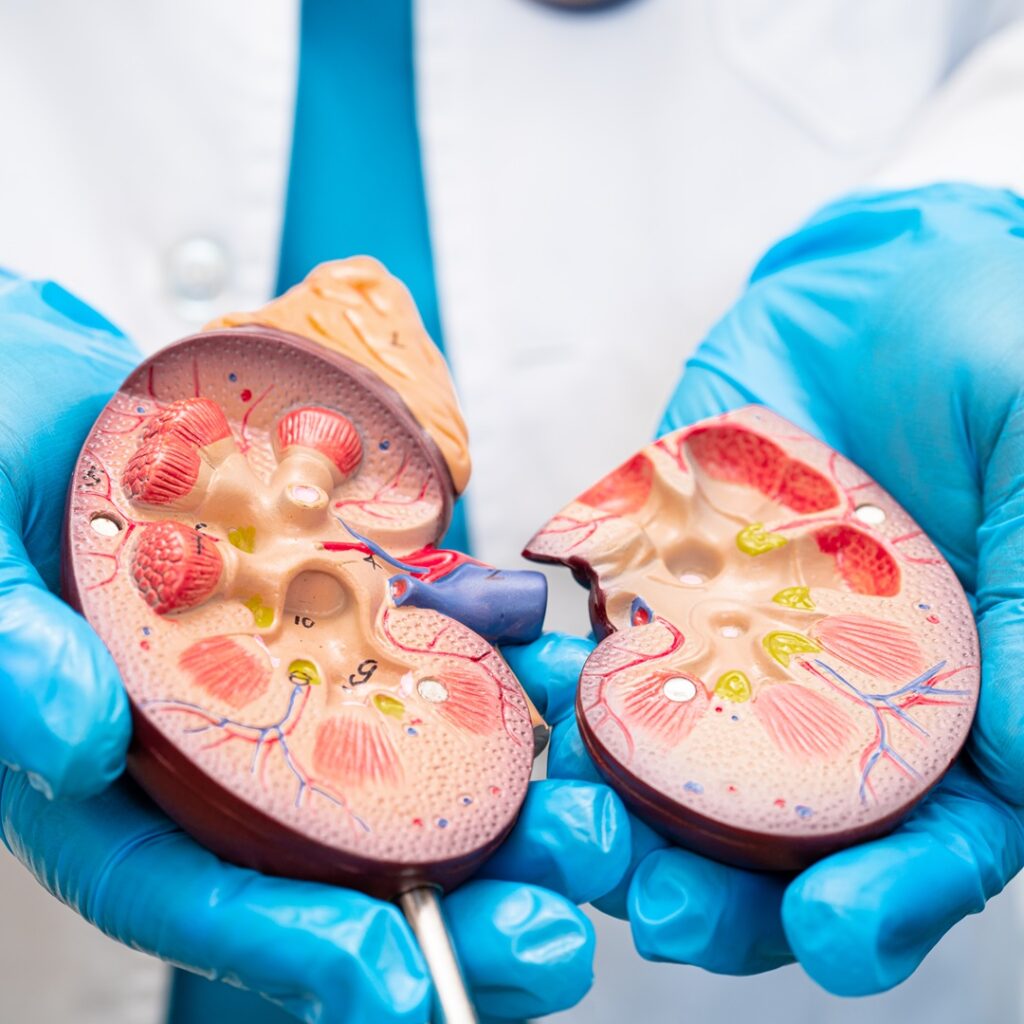 The Link Between Metabolic Disease, Prediabetes, and Kidney Stone Formation